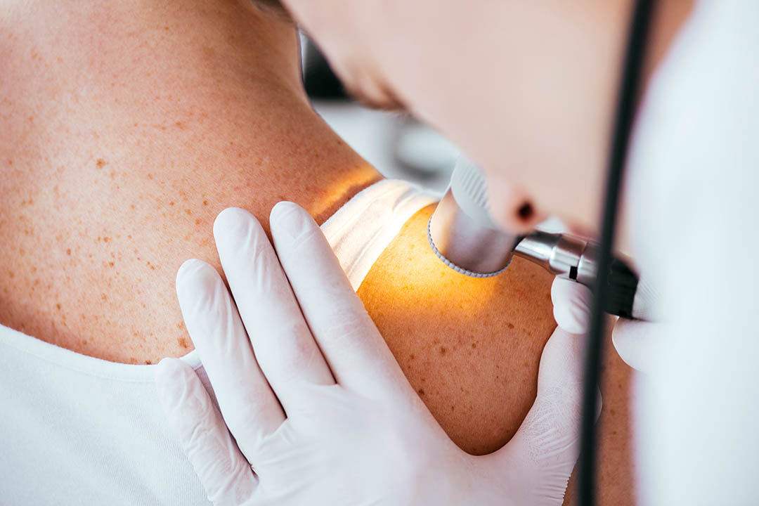 Dietary Fibre Improves Response to Melanoma Treatment